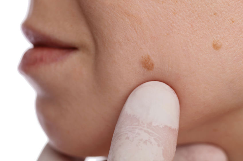 Cysts Warts Moles & Skin Tag Removal
