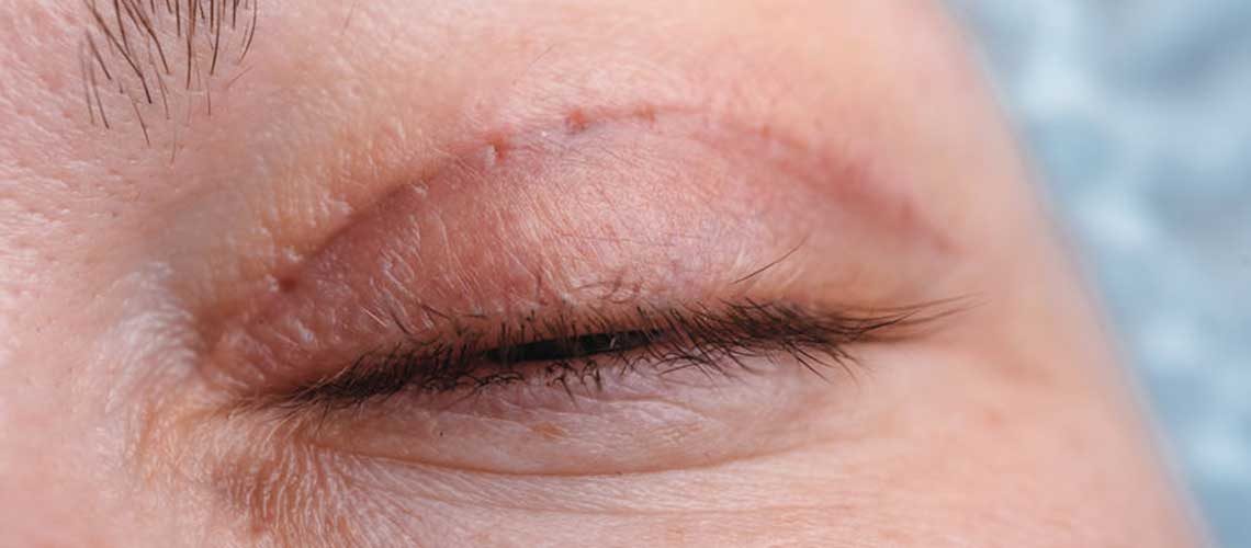 Blepharoplasty and headaches